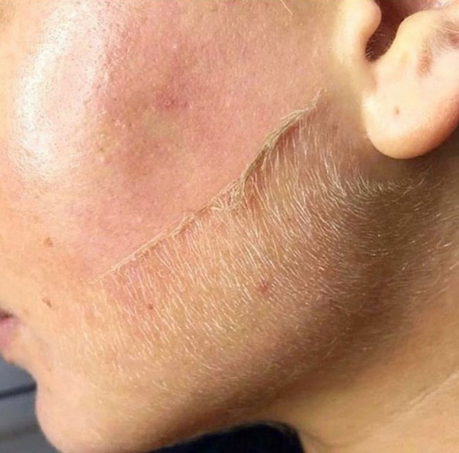 Dermaplane
