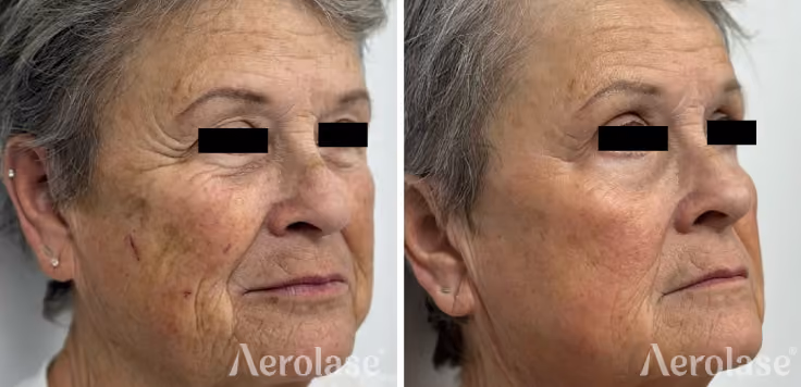 Aerolase treatment for sun damage wrinkles before and after